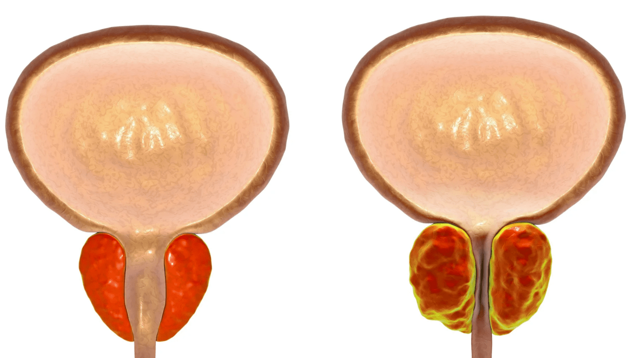 پروستاتیت چیست؟