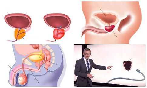پروستات سالم و بیمار
